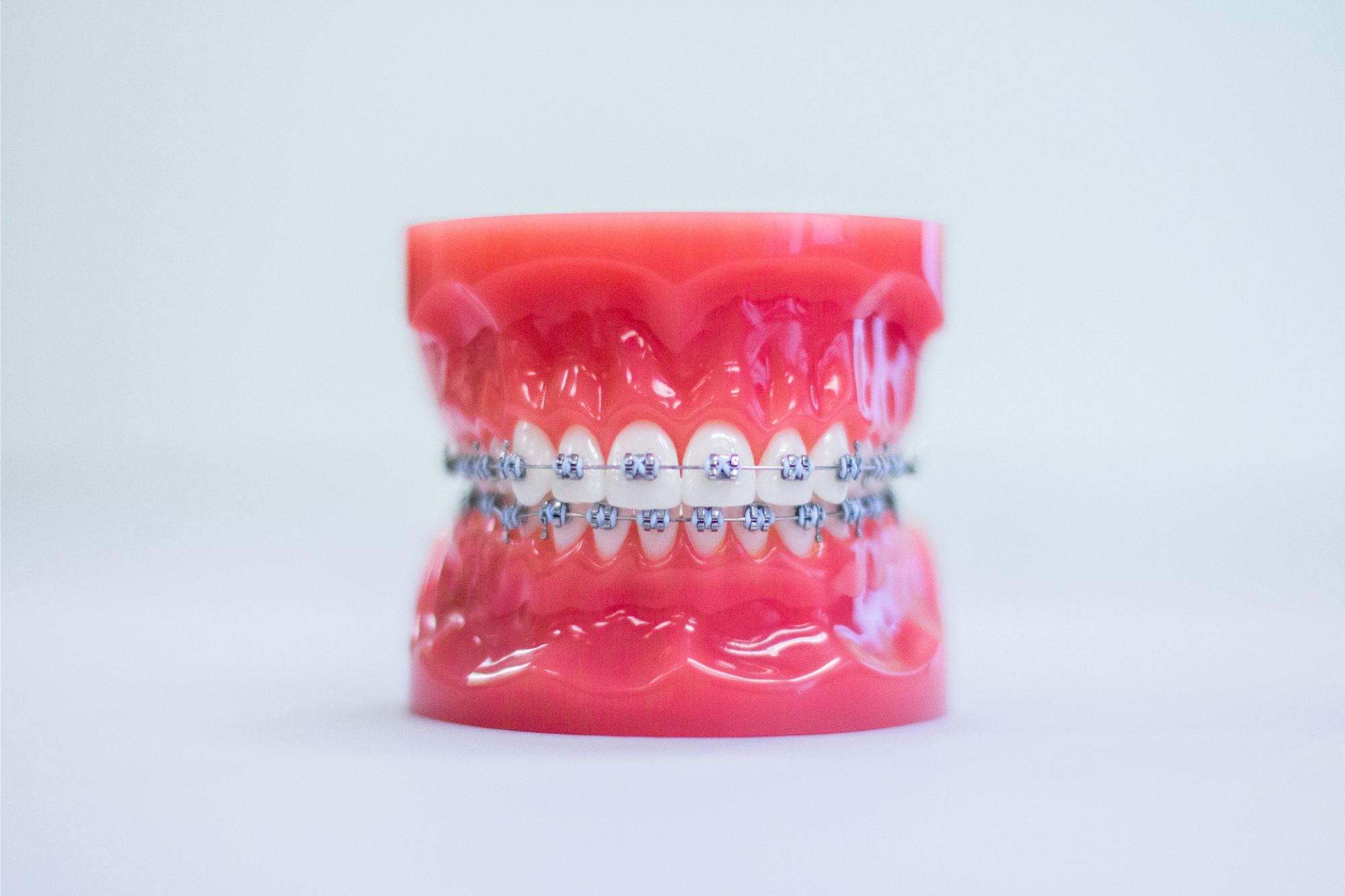 Traditional Braces