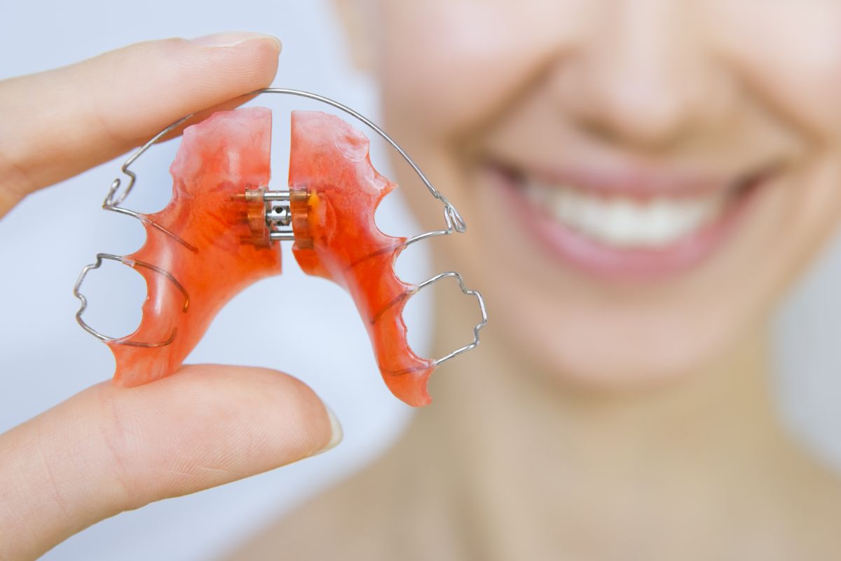 What Is a Palate Expander? Uses, How It Works and More