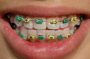 clear braces with purple bands