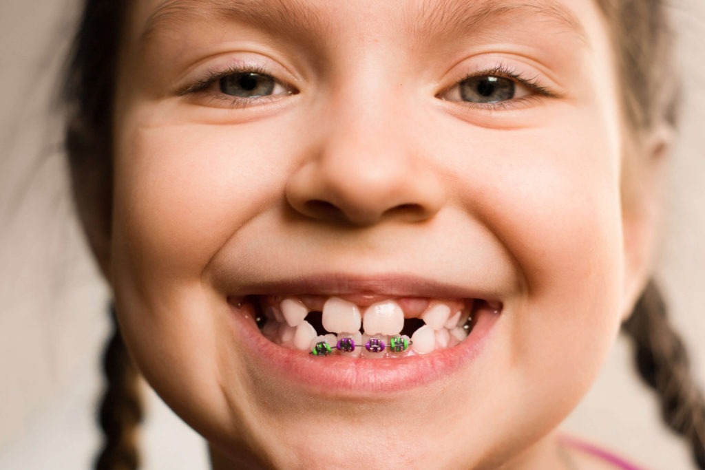 girl with braces on bottom