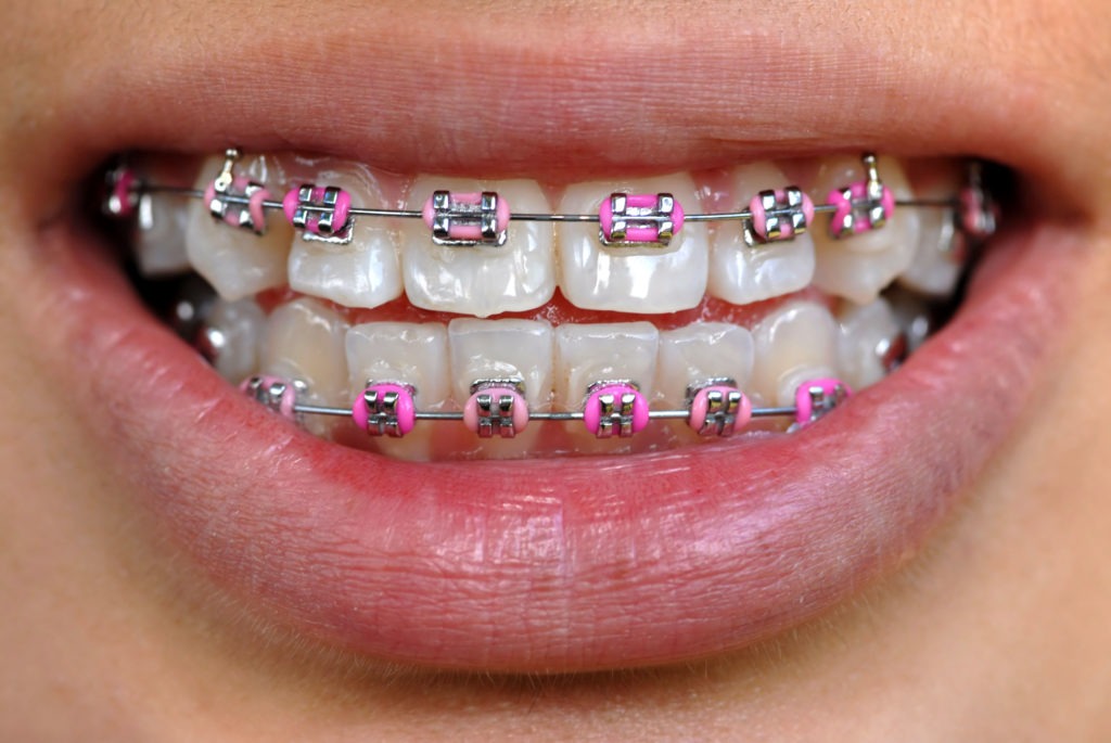 pink braces 