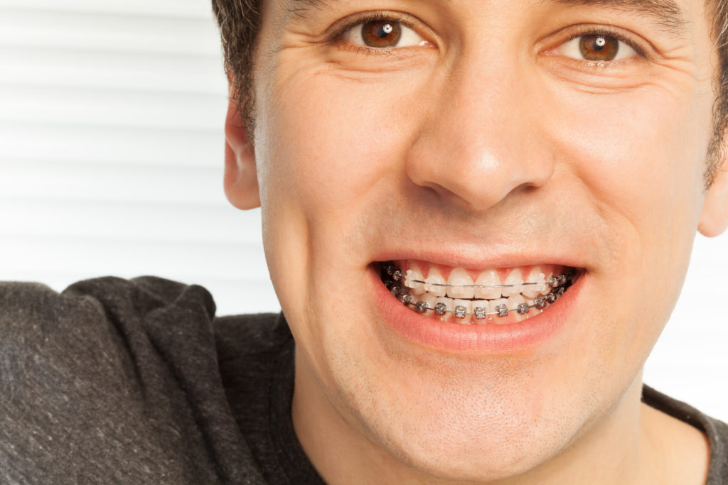 man with dental braces on his teeth