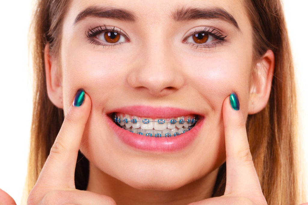 Woman smiling showing teeth with braces