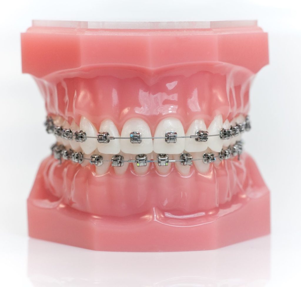 Seven Tips for Brushing Effectively with Braces