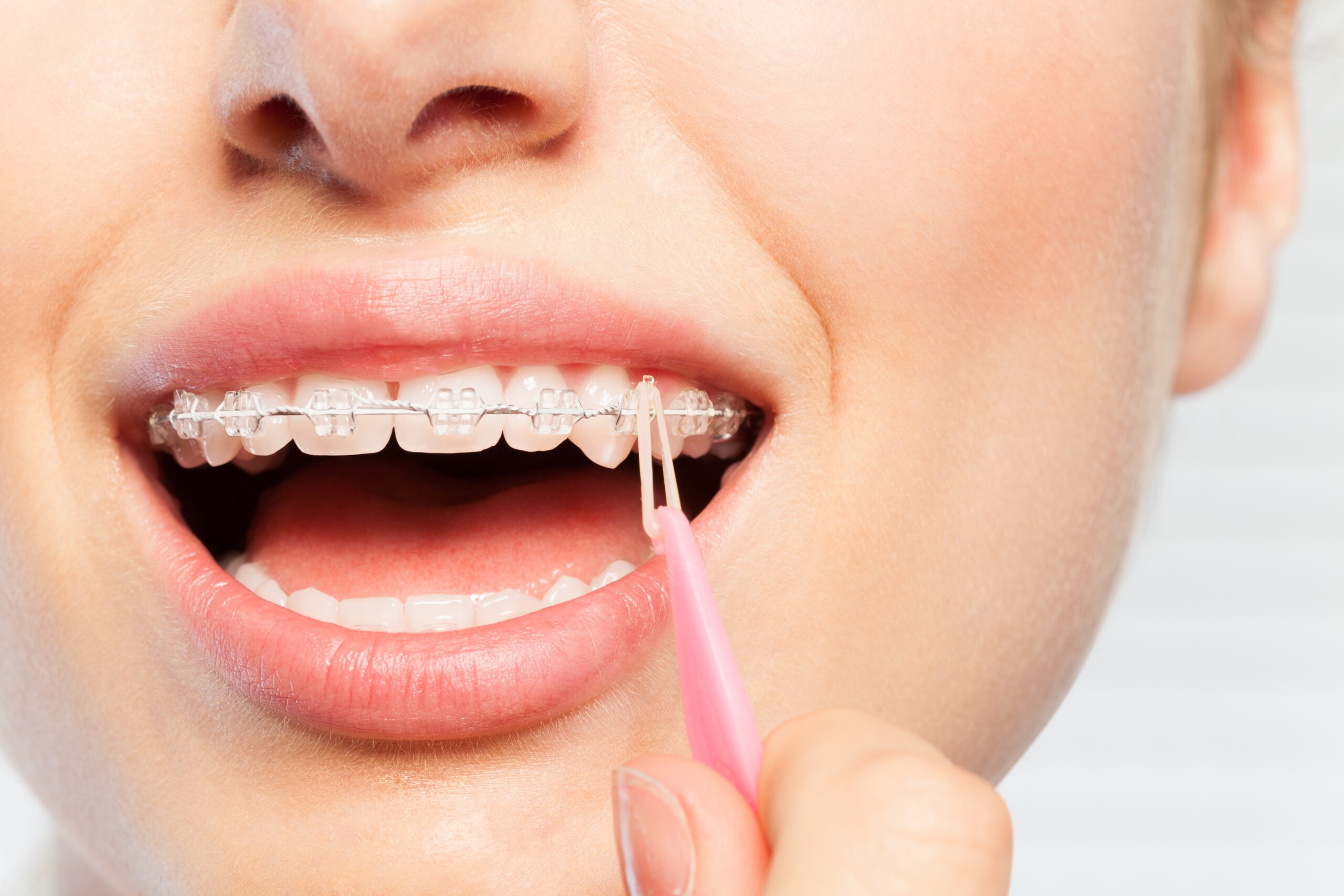 How Do Braces Work?