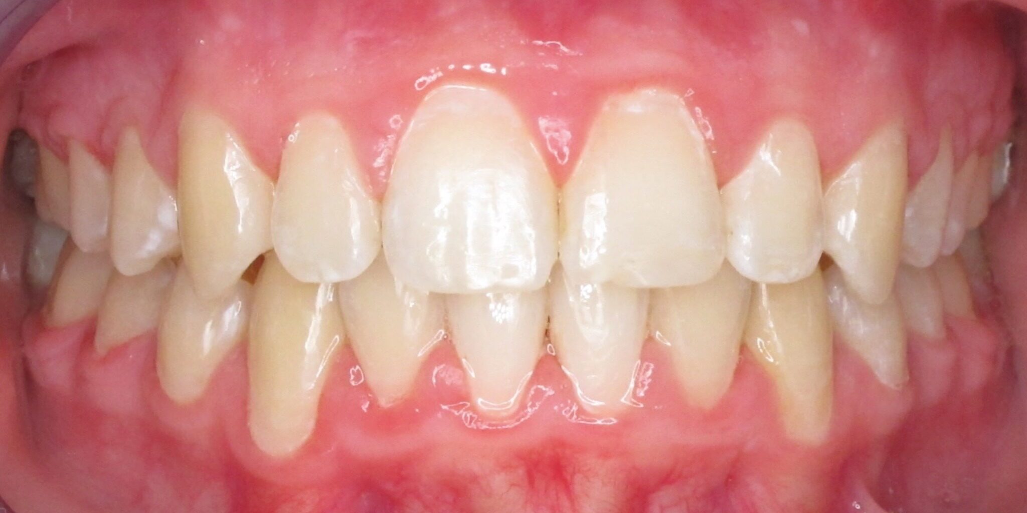 braces sammamish