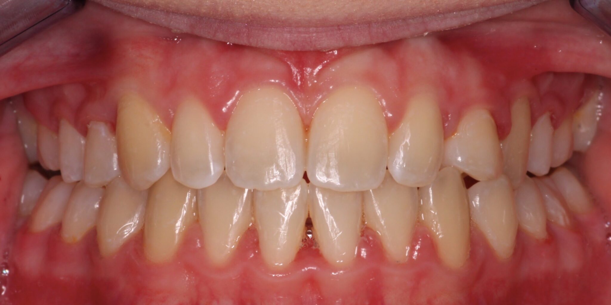 braces sammamish
