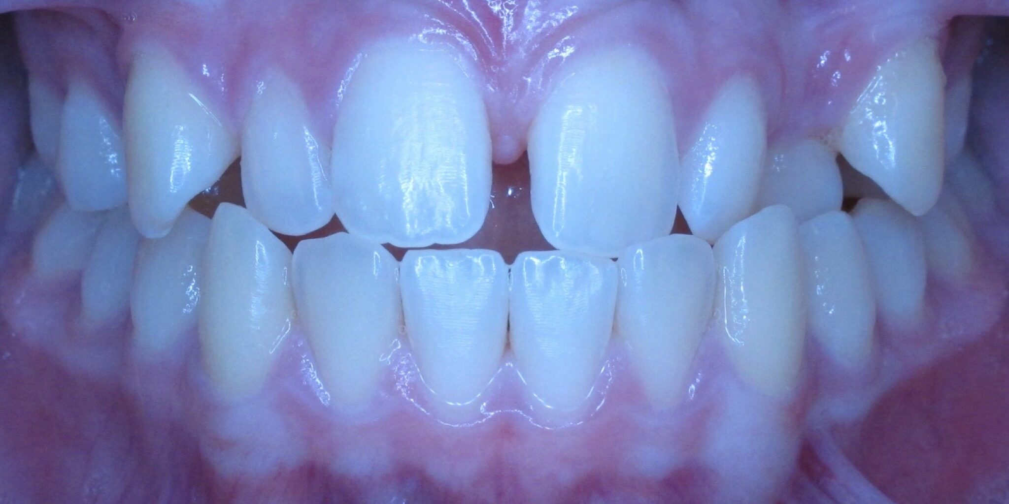 braces sammamish