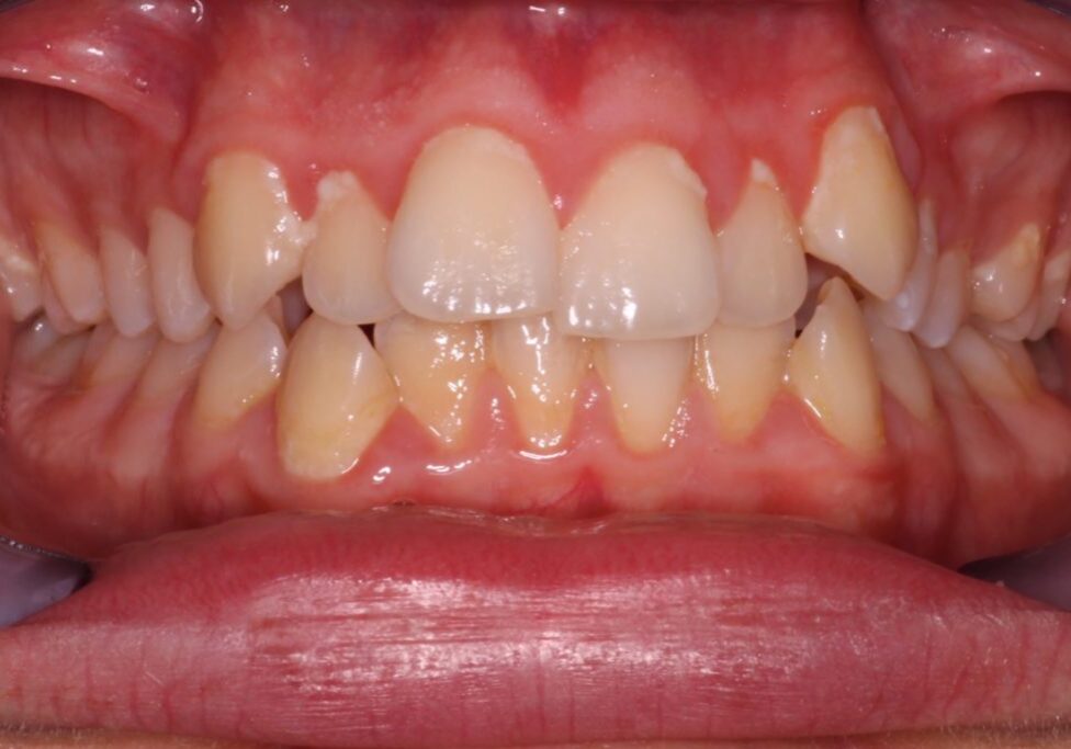 Maxim Teeth Before