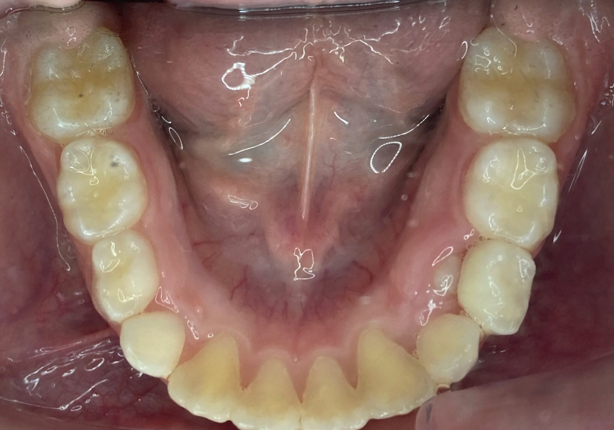 braces sammamish