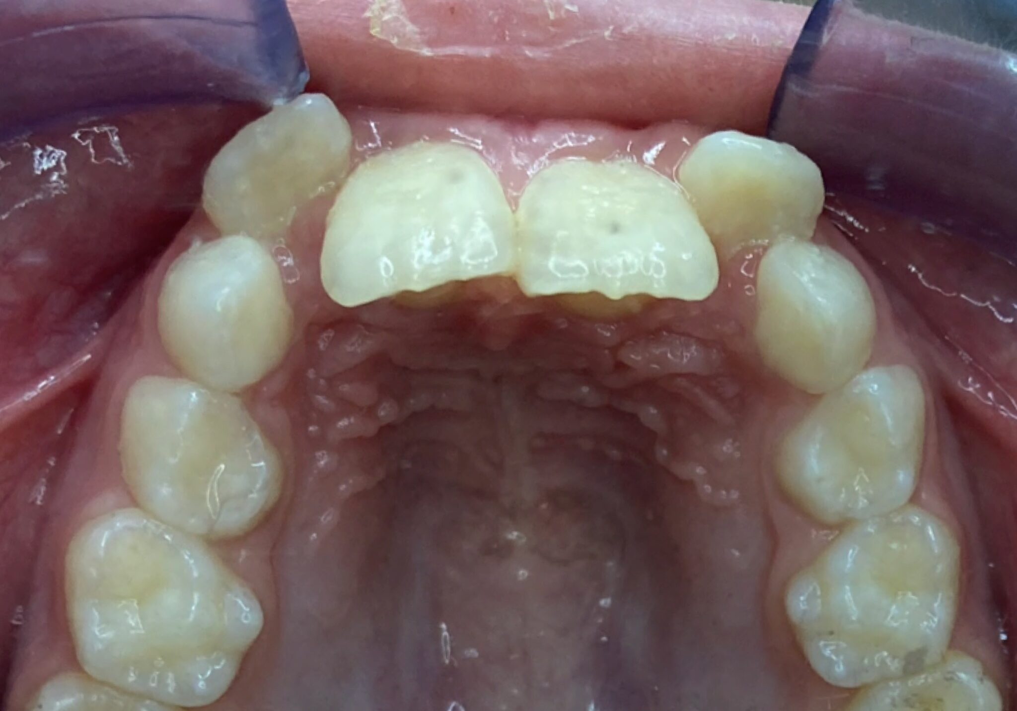 braces sammamish